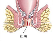 合肥治療肛裂 合肥肛腸專科醫(yī)院 合肥肛門醫(yī)院哪家好
