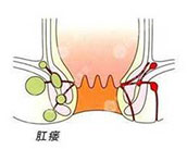 合肥治療肛瘺 合肥肛腸醫(yī)院 合肥肛門醫(yī)院哪家好